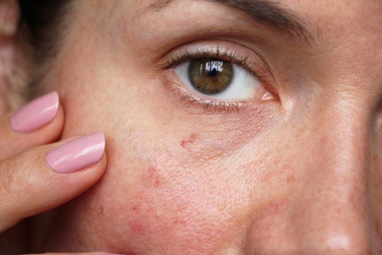Zabiegi kosmetologiczne nie dla wrażliwej skóry? Obalamy popularny mit i podpowiadamy, które z nich warto wykonać