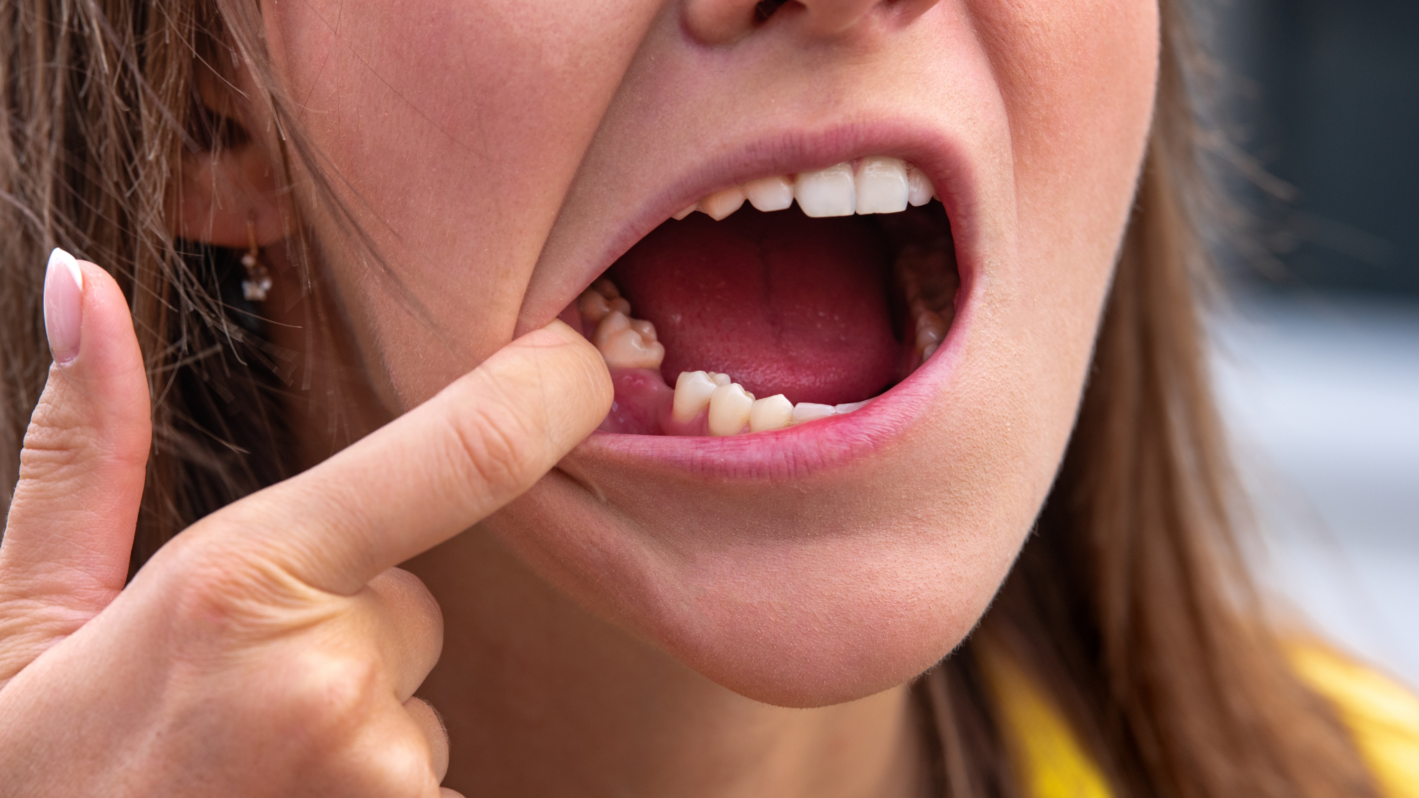 Gdy wypadł ząb – dlaczego należy go szybko odbudować?